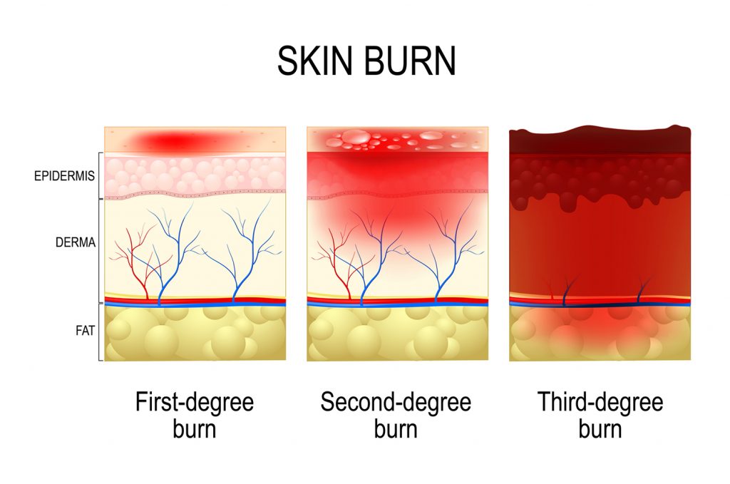 damage associated with a 4th degree burn