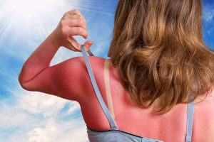 What Is The Best Way to Treat a Sunburn?