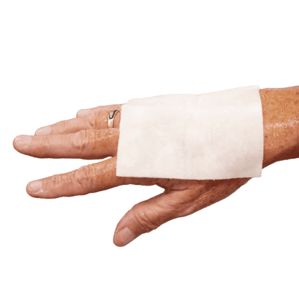 Burn Free burn dressing applied to hand.