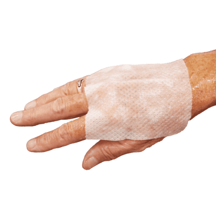Burn Stop Hydrogel Burn Dressing applied to hand
